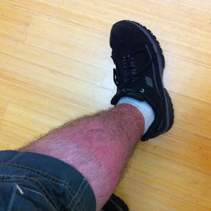 Here's what happens when my legs see sunlight for the first time in six years.