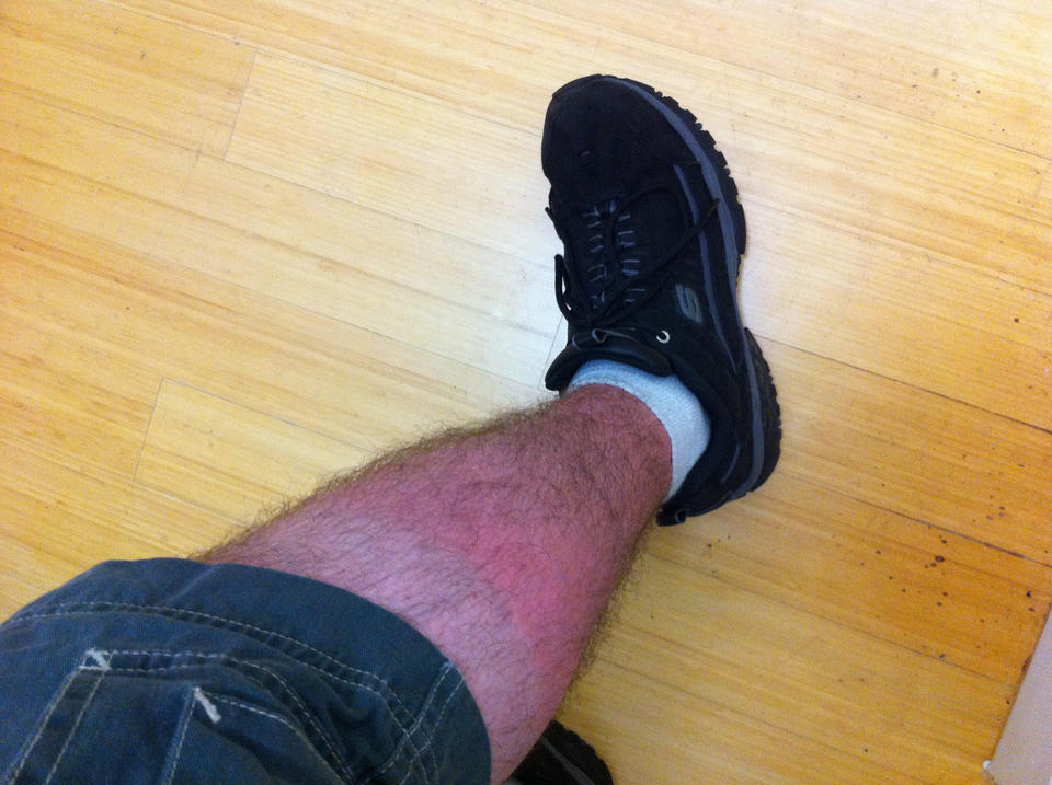 Here's what happens when my legs see sunlight for the first time in six years.